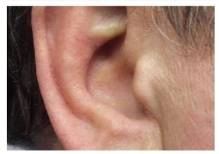 KAKO SIGURNO UKLONITI UŠNI VOSAK: METODE PREPORUČENE OD PEDIJATRA DR. GILA KAKO SIGURNO UKLONITI UŠNI VOSAK: METODE PREPORUČENE OD PEDIJATRA DR. GILA