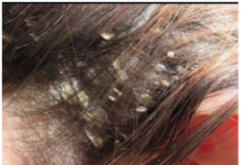 KOSA VAM JE MASNA I PUNA PERUTI: Uzmite ovu namirnicu i utrljajte u tjeme, ZA 5 SEKUNDI IZGLEDA KAO TEK OPRANA KOSA VAM JE MASNA I PUNA PERUTI: Uzmite ovu namirnicu i utrljajte u tjeme, ZA 5 SEKUNDI IZGLEDA KAO TEK OPRANA