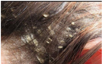 KOSA VAM JE MASNA I PUNA PERUTI: Uzmite ovu namirnicu i utrljajte u tjeme, ZA 5 SEKUNDI IZGLEDA KAO TEK OPRANA KOSA VAM JE MASNA I PUNA PERUTI: Uzmite ovu namirnicu i utrljajte u tjeme, ZA 5 SEKUNDI IZGLEDA KAO TEK OPRANA