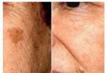 POZNATI DERMATOLOG OTKRIO: Ovo je uloga sode bikarbone u liječenju mrlja na licu! POZNATI DERMATOLOG OTKRIO: Ovo je uloga sode bikarbone u liječenju mrlja na licu!