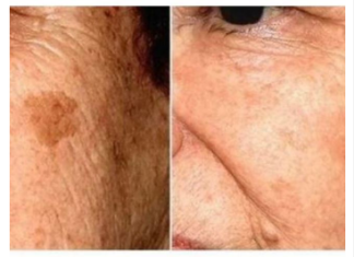 POZNATI DERMATOLOG OTKRIO: Ovo je uloga sode bikarbone u liječenju mrlja na licu! POZNATI DERMATOLOG OTKRIO: Ovo je uloga sode bikarbone u liječenju mrlja na licu!