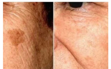 POZNATI DERMATOLOG OTKRIO: Ovo je uloga sode bikarbone u liječenju mrlja na licu! POZNATI DERMATOLOG OTKRIO: Ovo je uloga sode bikarbone u liječenju mrlja na licu!