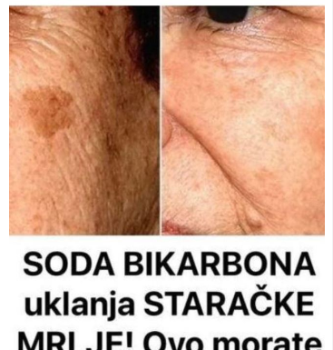 POZNATI DERMATOLOG OTKRIO: Ovo je uloga sode bikarbone u liječenju mrlja na licu! POZNATI DERMATOLOG OTKRIO: Ovo je uloga sode bikarbone u liječenju mrlja na licu!