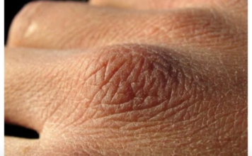 Puca vam koža, opada kosa ili imate grčeve? Tijelo vam govori da vam nedostaju ovi vitamini Puca vam koža, opada kosa ili imate grčeve? Tijelo vam govori da vam nedostaju ovi vitamini