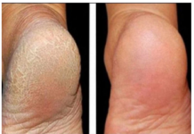 ZA MEKA STOPALA POTREBNA SU VAM SAMO 3 SASTOJKA IZ KUHINJE: Potopite noge u ovu smjesu na 15 minuta i recite zbogom ispucalim petama ZA MEKA STOPALA POTREBNA SU VAM SAMO 3 SASTOJKA IZ KUHINJE: Potopite noge u ovu smjesu na 15 minuta i recite zbogom ispucalim petama