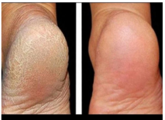 ZA MEKA STOPALA POTREBNA SU VAM SAMO 3 SASTOJKA IZ KUHINJE: Potopite noge u ovu smjesu na 15 minuta i recite zbogom ispucalim petama ZA MEKA STOPALA POTREBNA SU VAM SAMO 3 SASTOJKA IZ KUHINJE: Potopite noge u ovu smjesu na 15 minuta i recite zbogom ispucalim petama