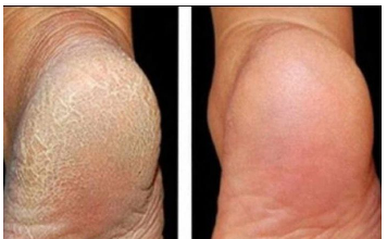 ZA MEKA STOPALA POTREBNA SU VAM SAMO 3 SASTOJKA IZ KUHINJE: Potopite noge u ovu smjesu na 15 minuta i recite zbogom ispucalim petama ZA MEKA STOPALA POTREBNA SU VAM SAMO 3 SASTOJKA IZ KUHINJE: Potopite noge u ovu smjesu na 15 minuta i recite zbogom ispucalim petama