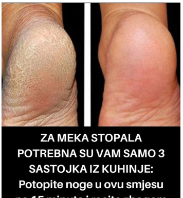 ZA MEKA STOPALA POTREBNA SU VAM SAMO 3 SASTOJKA IZ KUHINJE: Potopite noge u ovu smjesu na 15 minuta i recite zbogom ispucalim petama ZA MEKA STOPALA POTREBNA SU VAM SAMO 3 SASTOJKA IZ KUHINJE: Potopite noge u ovu smjesu na 15 minuta i recite zbogom ispucalim petama