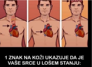 1 ZNAK NA KOŽI UKAZUJE DA JE VAŠE SRCE U LOŠEM STANJU: Ako ovo primijetite javite se doktoru ODMAH! 1 ZNAK NA KOŽI UKAZUJE DA JE VAŠE SRCE U LOŠEM STANJU: Ako ovo primijetite javite se doktoru ODMAH!
