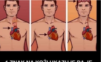 1 ZNAK NA KOŽI UKAZUJE DA JE VAŠE SRCE U LOŠEM STANJU: Ako ovo primijetite javite se doktoru ODMAH! 1 ZNAK NA KOŽI UKAZUJE DA JE VAŠE SRCE U LOŠEM STANJU: Ako ovo primijetite javite se doktoru ODMAH!
