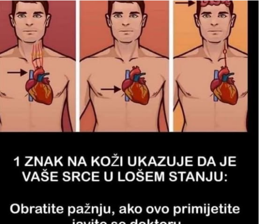 1 ZNAK NA KOŽI UKAZUJE DA JE VAŠE SRCE U LOŠEM STANJU: Ako ovo primijetite javite se doktoru ODMAH! 1 ZNAK NA KOŽI UKAZUJE DA JE VAŠE SRCE U LOŠEM STANJU: Ako ovo primijetite javite se doktoru ODMAH!