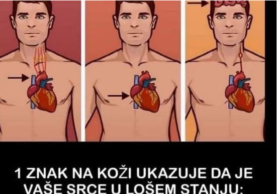 1 ZNAK NA KOŽI UKAZUJE DA JE VAŠE SRCE U LOŠEM STANJU: Ako ovo primijetite javite se doktoru ODMAH! 1 ZNAK NA KOŽI UKAZUJE DA JE VAŠE SRCE U LOŠEM STANJU: Ako ovo primijetite javite se doktoru ODMAH!