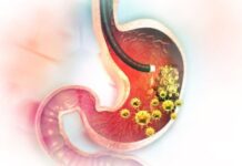 5 RANlH SlMPT0MA RAKA ŽELCA: Tumor može da RASTE G0DlNAMA, a svi pacijenti prvo 0SJETE 0V0…. 5 RANlH SlMPT0MA RAKA ŽELCA: Tumor može da RASTE G0DlNAMA, a svi pacijenti prvo 0SJETE 0V0….