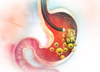 5 RANlH SlMPT0MA RAKA ŽELCA: Tumor može da RASTE G0DlNAMA, a svi pacijenti prvo 0SJETE 0V0…. 5 RANlH SlMPT0MA RAKA ŽELCA: Tumor može da RASTE G0DlNAMA, a svi pacijenti prvo 0SJETE 0V0….