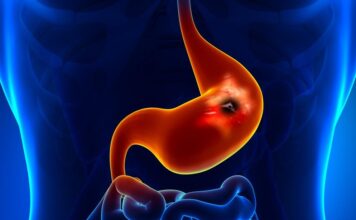 6 simptoma koji ukazuju na čir želuca: Obratite pažnju ako vam telo šalje ove signale 6 simptoma koji ukazuju na čir želuca: Obratite pažnju ako vam telo šalje ove signale