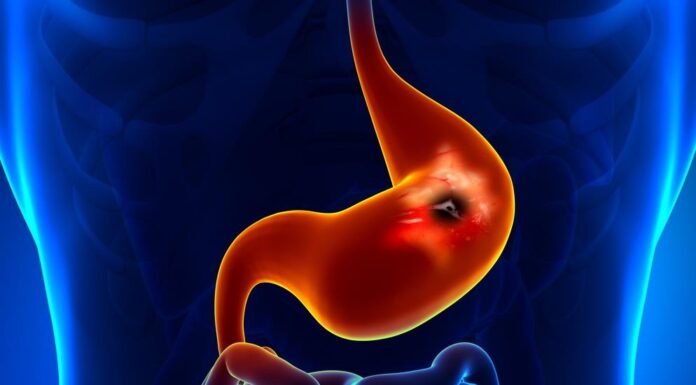 6 simptoma koji ukazuju na čir želuca: Obratite pažnju ako vam telo šalje ove signale 6 simptoma koji ukazuju na čir želuca: Obratite pažnju ako vam telo šalje ove signale