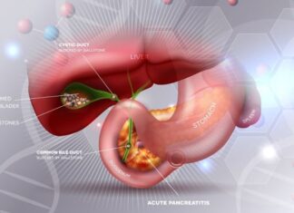 Koja hrana je strogo zabranjena ljudima sa kamenom u žuči? Može da pokrene napad ili upalu Koja hrana je strogo zabranjena ljudima sa kamenom u žuči? Može da pokrene napad ili upalu