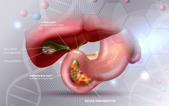 Koja hrana je strogo zabranjena ljudima sa kamenom u žuči? Može da pokrene napad ili upalu Koja hrana je strogo zabranjena ljudima sa kamenom u žuči? Može da pokrene napad ili upalu