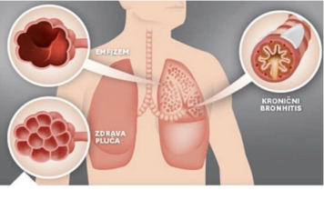 NAŠE BAKE SU NAJBOLJE ZNALE: Evo kako izliječiti astmu, bronhitis i plućne bolesti NAŠE BAKE SU NAJBOLJE ZNALE: Evo kako izliječiti astmu, bronhitis i plućne bolesti