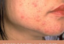 OPREZ! RODITELJI, OBRATITE PAŽNJU NA OVO! Ove navike mogu spasiti kožu vaše djece od akni, VAŽNO JE DA POČNETE ODMAH OPREZ! RODITELJI, OBRATITE PAŽNJU NA OVO! Ove navike mogu spasiti kožu vaše djece od akni, VAŽNO JE DA POČNETE ODMAH