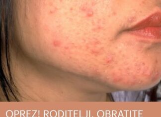 OPREZ! RODITELJI, OBRATITE PAŽNJU NA OVO! Ove navike mogu spasiti kožu vaše djece od akni, VAŽNO JE DA POČNETE ODMAH OPREZ! RODITELJI, OBRATITE PAŽNJU NA OVO! Ove navike mogu spasiti kožu vaše djece od akni, VAŽNO JE DA POČNETE ODMAH