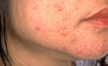 OPREZ! RODITELJI, OBRATITE PAŽNJU NA OVO! Ove navike mogu spasiti kožu vaše djece od akni, VAŽNO JE DA POČNETE ODMAH OPREZ! RODITELJI, OBRATITE PAŽNJU NA OVO! Ove navike mogu spasiti kožu vaše djece od akni, VAŽNO JE DA POČNETE ODMAH