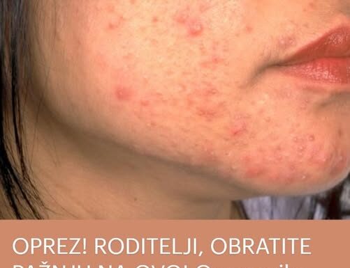 OPREZ! RODITELJI, OBRATITE PAŽNJU NA OVO! Ove navike mogu spasiti kožu vaše djece od akni, VAŽNO JE DA POČNETE ODMAH OPREZ! RODITELJI, OBRATITE PAŽNJU NA OVO! Ove navike mogu spasiti kožu vaše djece od akni, VAŽNO JE DA POČNETE ODMAH