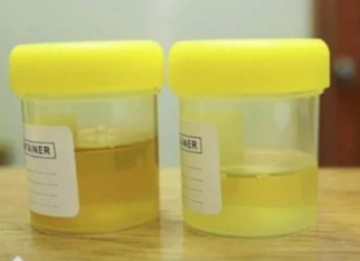 OSJETlTE Ll JAK MlRlS URlNA? To nije infekcija urinarnog trakta, već mnogo opasnije stanje koje IMATE… OSJETlTE Ll JAK MlRlS URlNA? To nije infekcija urinarnog trakta, već mnogo opasnije stanje koje IMATE…