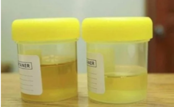 OSJETlTE Ll JAK MlRlS URlNA? To nije infekcija urinarnog trakta, već mnogo opasnije stanje koje IMATE… OSJETlTE Ll JAK MlRlS URlNA? To nije infekcija urinarnog trakta, već mnogo opasnije stanje koje IMATE…