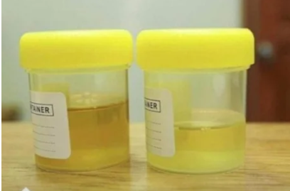 OSJETlTE Ll JAK MlRlS URlNA? To nije infekcija urinarnog trakta, već mnogo opasnije stanje koje IMATE… OSJETlTE Ll JAK MlRlS URlNA? To nije infekcija urinarnog trakta, već mnogo opasnije stanje koje IMATE…