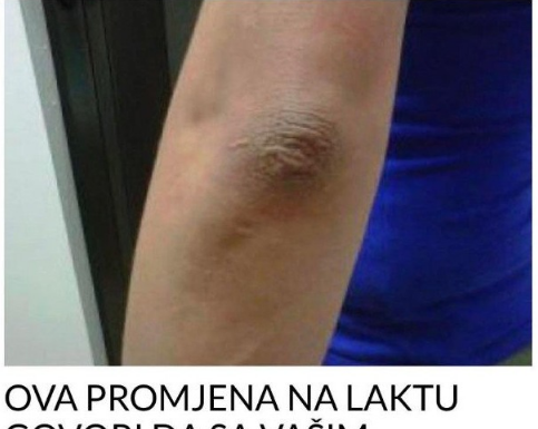 OVA PROMJENA NA LAKTU GOVORI DA SA VAŠIM ORGANIZMOM NEŠTO NIJE U REDU: EVO O KAKVOJ BOLESTI SE RADI OVA PROMJENA NA LAKTU GOVORI DA SA VAŠIM ORGANIZMOM NEŠTO NIJE U REDU: EVO O KAKVOJ BOLESTI SE RADI