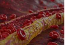 Ovi znaci na nogama pokazuju da imate izuzetno visok holesterol: Ne smijete ih ignorisati, posljedice su fatalne po tijelo Ovi znaci na nogama pokazuju da imate izuzetno visok holesterol: Ne smijete ih ignorisati, posljedice su fatalne po tijelo