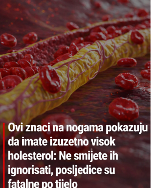 Ovi znaci na nogama pokazuju da imate izuzetno visok holesterol: Ne smijete ih ignorisati, posljedice su fatalne po tijelo Ovi znaci na nogama pokazuju da imate izuzetno visok holesterol: Ne smijete ih ignorisati, posljedice su fatalne po tijelo