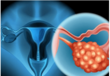 4 RANA SIMPTOMA RAKA JAJNIKA: Svaka žena ovo treba znati, JEDAN SIMPTOM NIKAKO NE SMIJETE IGNORISATI 4 RANA SIMPTOMA RAKA JAJNIKA: Svaka žena ovo treba znati, JEDAN SIMPTOM NIKAKO NE SMIJETE IGNORISATI