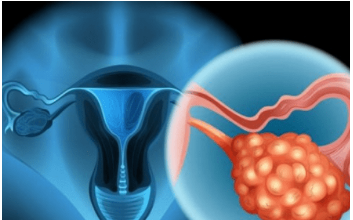 4 RANA SIMPTOMA RAKA JAJNIKA: Svaka žena ovo treba znati, JEDAN SIMPTOM NIKAKO NE SMIJETE IGNORISATI 4 RANA SIMPTOMA RAKA JAJNIKA: Svaka žena ovo treba znati, JEDAN SIMPTOM NIKAKO NE SMIJETE IGNORISATI
