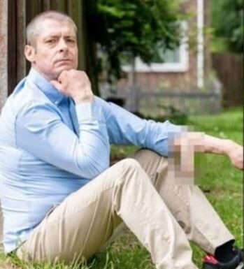 Kad mu je otpao polni organ, doktori mu novi presadili na ruku: Način na koji doživljava vrhunac je bizaran Kad mu je otpao polni organ, doktori mu novi presadili na ruku: Način na koji doživljava vrhunac je bizaran