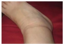 KAD SKINETE ČARAPE OSTANU VAM TRAGOVI NA NOGAMA: Evo šta se dešava sa vašim zdravljem KAD SKINETE ČARAPE OSTANU VAM TRAGOVI NA NOGAMA: Evo šta se dešava sa vašim zdravljem