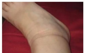 KAD SKINETE ČARAPE OSTANU VAM TRAGOVI NA NOGAMA: Evo šta se dešava sa vašim zdravljem KAD SKINETE ČARAPE OSTANU VAM TRAGOVI NA NOGAMA: Evo šta se dešava sa vašim zdravljem