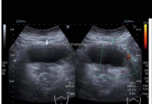 RAK BUBREGA IMA 6 SIMPTOMA – TEŠKO SE PREPOZNAJU: Posebno obratite pažnju na broj 2 RAK BUBREGA IMA 6 SIMPTOMA – TEŠKO SE PREPOZNAJU: Posebno obratite pažnju na broj 2