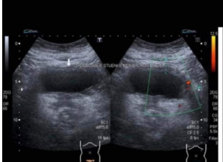 RAK BUBREGA IMA 6 SIMPTOMA – TEŠKO SE PREPOZNAJU: Posebno obratite pažnju na broj 2 RAK BUBREGA IMA 6 SIMPTOMA – TEŠKO SE PREPOZNAJU: Posebno obratite pažnju na broj 2