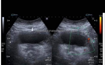 RAK BUBREGA IMA 6 SIMPTOMA – TEŠKO SE PREPOZNAJU: Posebno obratite pažnju na broj 2 RAK BUBREGA IMA 6 SIMPTOMA – TEŠKO SE PREPOZNAJU: Posebno obratite pažnju na broj 2