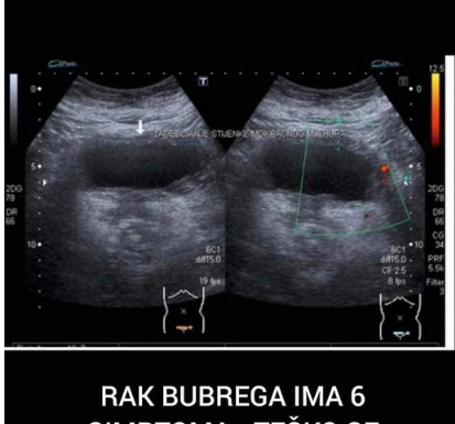 RAK BUBREGA IMA 6 SIMPTOMA – TEŠKO SE PREPOZNAJU: Posebno obratite pažnju na broj 2 RAK BUBREGA IMA 6 SIMPTOMA – TEŠKO SE PREPOZNAJU: Posebno obratite pažnju na broj 2