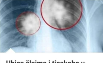 UB0JlCA SLUZl l TJESK0BE U GRUDlMA: Mješavina 3 sastojka za liječenje pluća i disajnih puteva… UB0JlCA SLUZl l TJESK0BE U GRUDlMA: Mješavina 3 sastojka za liječenje pluća i disajnih puteva…