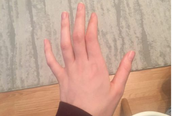 OBAVEZNO OBRATITE PAŽNJU: Ako vam trnu prsti, to može da znači nekoliko stvari, a ovo je uzrok OBAVEZNO OBRATITE PAŽNJU: Ako vam trnu prsti, to može da znači nekoliko stvari, a ovo je uzrok