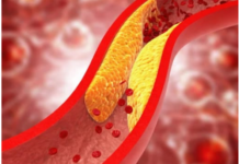 1 ZNAK DOK HODAMO UKAZUJE NA POVIŠEN HOLESTEROL 1 ZNAK DOK HODAMO UKAZUJE NA POVIŠEN HOLESTEROL