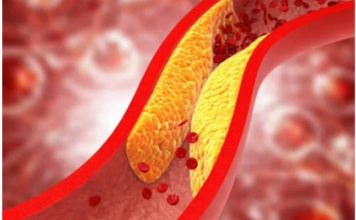 1 ZNAK DOK HODAMO UKAZUJE NA POVIŠEN HOLESTEROL 1 ZNAK DOK HODAMO UKAZUJE NA POVIŠEN HOLESTEROL