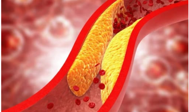 1 ZNAK DOK HODAMO UKAZUJE NA POVIŠEN HOLESTEROL 1 ZNAK DOK HODAMO UKAZUJE NA POVIŠEN HOLESTEROL