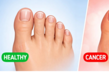 5 Podmuklih znakova na noktima na nogama koji mogu ukazivati na skrivene zdravstvene probleme 5 Podmuklih znakova na noktima na nogama koji mogu ukazivati na skrivene zdravstvene probleme