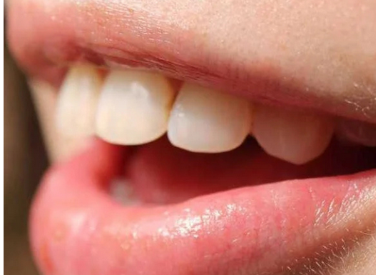 Krvarenje desni može biti znak da vam nedostaje jedna važna stvar Krvarenje desni može biti znak da vam nedostaje jedna važna stvar