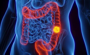 Ova tri “bezopasna” simptoma mogu ukazivati na rak debelog creva: Nisu pošteđeni ni mladi, a obično se pripisuju stresu Ova tri "bezopasna" simptoma mogu ukazivati na rak debelog creva: Nisu pošteđeni ni mladi, a obično se pripisuju stresu